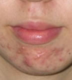Pre-treatment