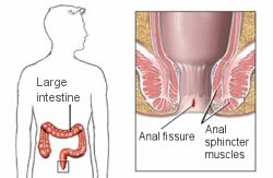 Anal Fissure
