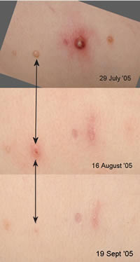 molluscum case history