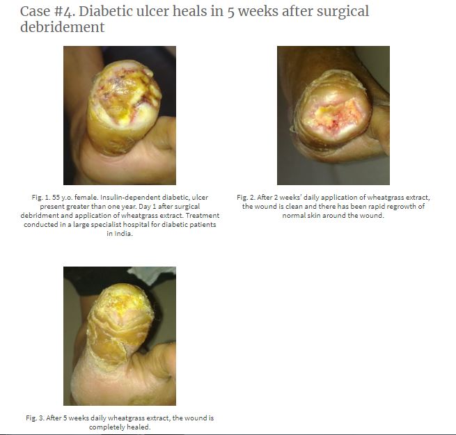 糖尿病性足潰瘍ウィートグラス療法回復経過症例4