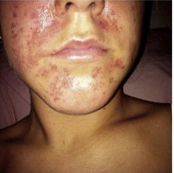 女性　顔　アレルギー反応　　