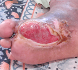 糖尿病性の足潰瘍　右足　ウィートグラス療法開始例1