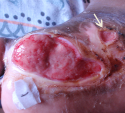 糖尿病性の足潰瘍　右足　ウィートグラス療法経過例2